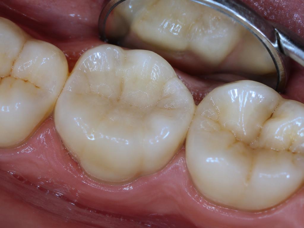 Aesthetic fillings